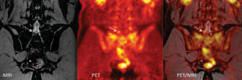 Imagen: Una resonancia magnética coronal, PET, y la imagen PET/RM fusionada de un paciente que sufre de ciática crónica del lado derecho (Fotografía cortesía de Sandip Biswal, MD).