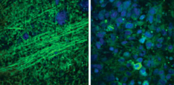 Imagen: Un cerebro normal (izquierda), donde se aprecian los axones bajo microscopía SRS, en comparación con el tejido desordenado de un tumor (derecha) cerebral (Fotografía cortesía de la U-M).