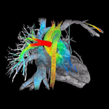 Imagen: La representación a color ViosWorks de la dirección y velocidad del flujo sanguíneo cardíaco (Fotografía cortesía de GE Healthcare).