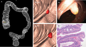 Imagen: Una Colonografía por Tomografía Computarizada (CTC) con imágenes en 3D, del pólipo de un adenoma avanzado que está evolucionando en el colon ascendente (Fotografía cortesía de la RSNA).