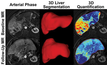 Imagen: Imágenes de hígado de antes y después del tratamiento. La imagen inferior derecha muestra que menos cáncer es visible después del tratamiento (Fotografía cortesía de la RSNA).