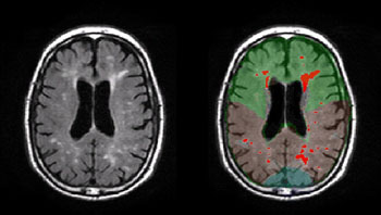 Imagen: La WMH en el cerebro de pacientes con enfermedad de Alzheimer (Fotografía cortesía de Adam Brickman/Universidad de Columbia).