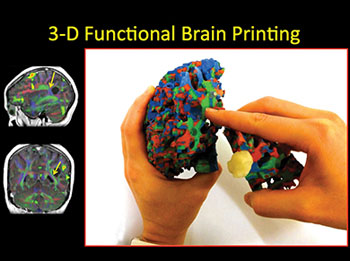 Imagen: Imprimir una copia en 3D del cerebro es una herramienta educativa útil para las comunicaciones entre los radiólogos y los pacientes con tumores cerebrales (Fotografía cortesía de la RSNA).