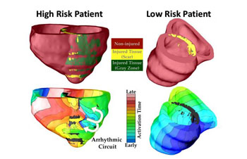 Imagen: El gráfico muestra cómo se utilizó el modelo de computador VARP 3D para clasificar a los pacientes con riesgo alto y con riesgo bajo de sufrir arritmia cardíaca (Fotografía cortesía de Royce Faddis/JHU).