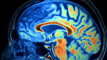 Imagen: Una imagen de resonancia magnética que muestra la disminución del tamaño de los lóbulos frontal y temporal, indicativos de demencia (Fotografía cortesía de SPL).
