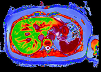 Imagen: Una imagen post-bariátrica de un hígado con LiverMultiScan (Fotografía cortesía de Perspectum Diagnostics).