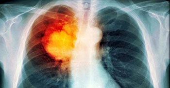 Imagen: Una imagen de TEP del cáncer de pulmón (Fotografía cortesía de TDMU).