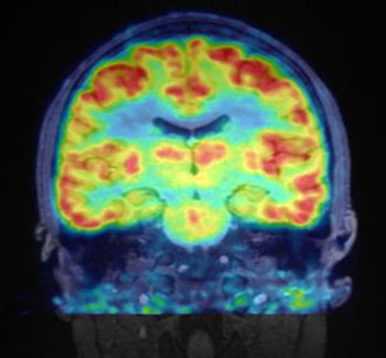 Imagen: Una imagen RM-TEP del cerebro humano utilizando Martinostat (Fotografía cortesía de NMR).