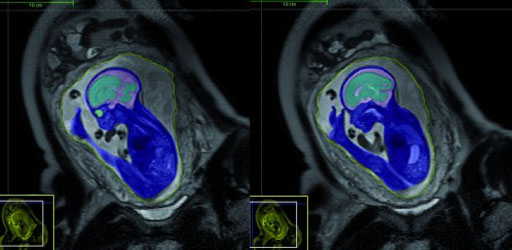 Imagen: Un ejemplo de un examen de resonancia magnética (RM) de un feto (Fotografía cortesía de Action Medical Research).