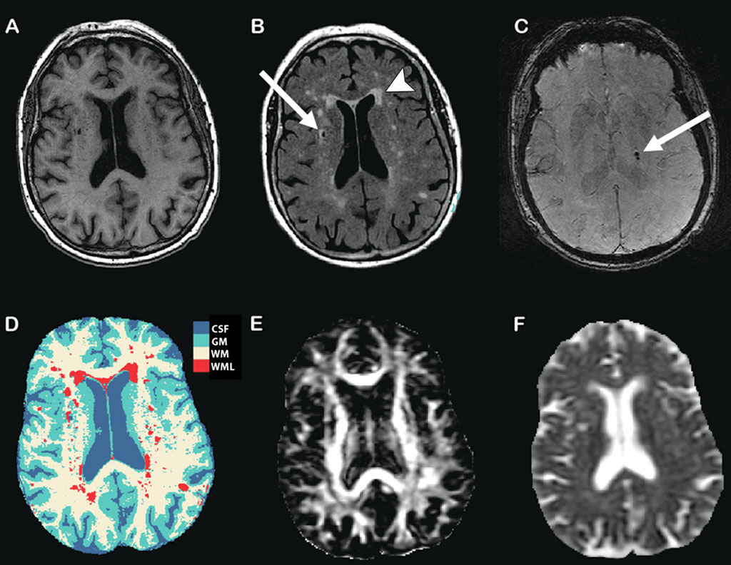 Imagen: Los marcadores estructurales de imagenología del daño cerebral subclínico, vistos con la resonancia magnética (Fotografía cortesía de RSNA).