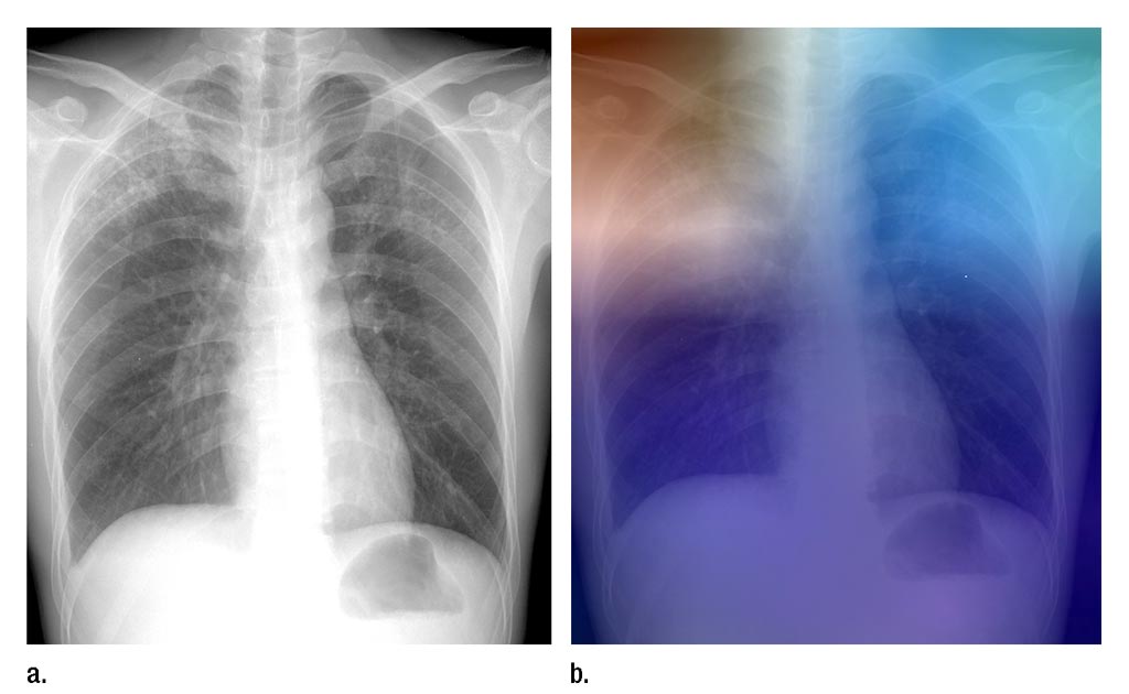 Imagen: Una radiografía de tórax de un paciente con TB activa, y una radiografía con una superposición de mapa de calor que muestra algunos de los resultados del análisis usando la inteligencia artificial (Fotografía cortesía de la RSNA).