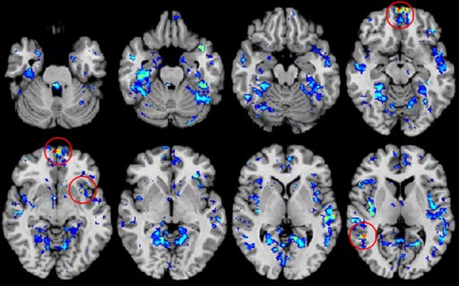 Imagen: Exámenes del cerebro usando resonancia magnética funcional (fMRI) destinados a identificar biomarcadores para el autismo (Fotografía cortesía de SpectrumNews).