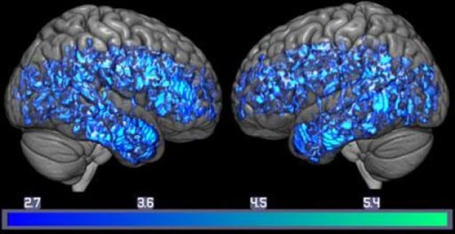 Imagen: Un cerebro con una disminución de los transportadores de serotonina (azul) para todo el grupo de deterioro cognitivo leve, y un examen cerebral de todo el grupo control sano (Fotografía cortesía del Laboratorio de Gwenn Smith).
