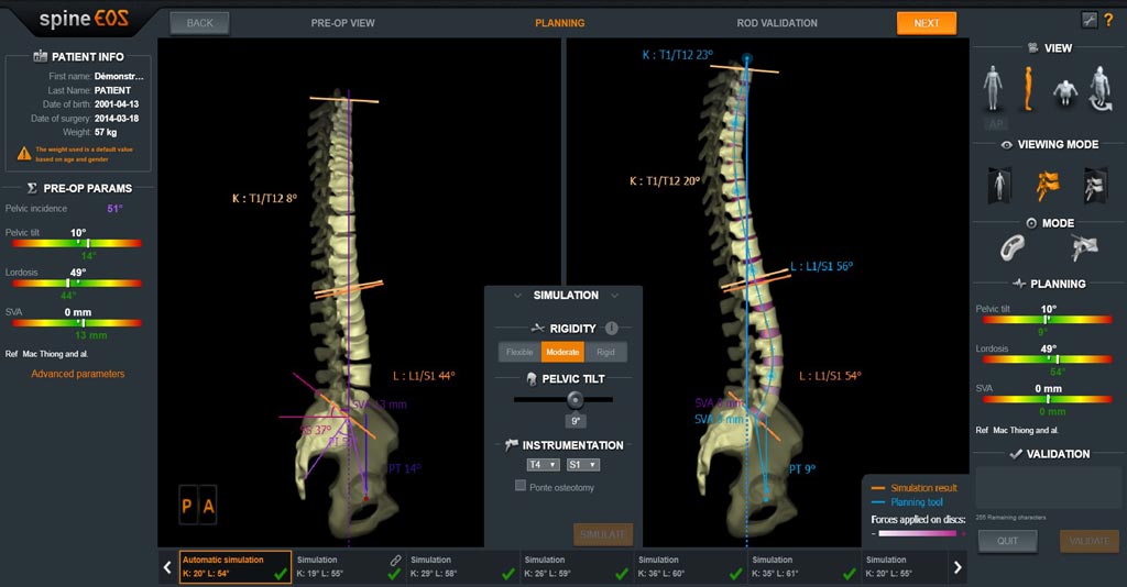 Imagen: La imagen muestra el nuevo software de planificación y simulación de cirugía de columna spineEOS que incluye una simulación biomecánica personalizada (Fotografía cortesía de EOS Imaging).