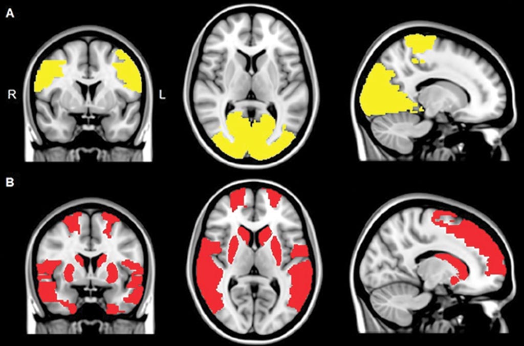 Imagen: Las imágenes de resonancia magnética (RM) muestran una reducción de la conectividad funcional regional en los pacientes con enfermedad de Parkinson (A), y en los pacientes con Parkinson, así como en pacientes con alucinaciones visuales (B) (Fotografía cortesía de la RSNA).