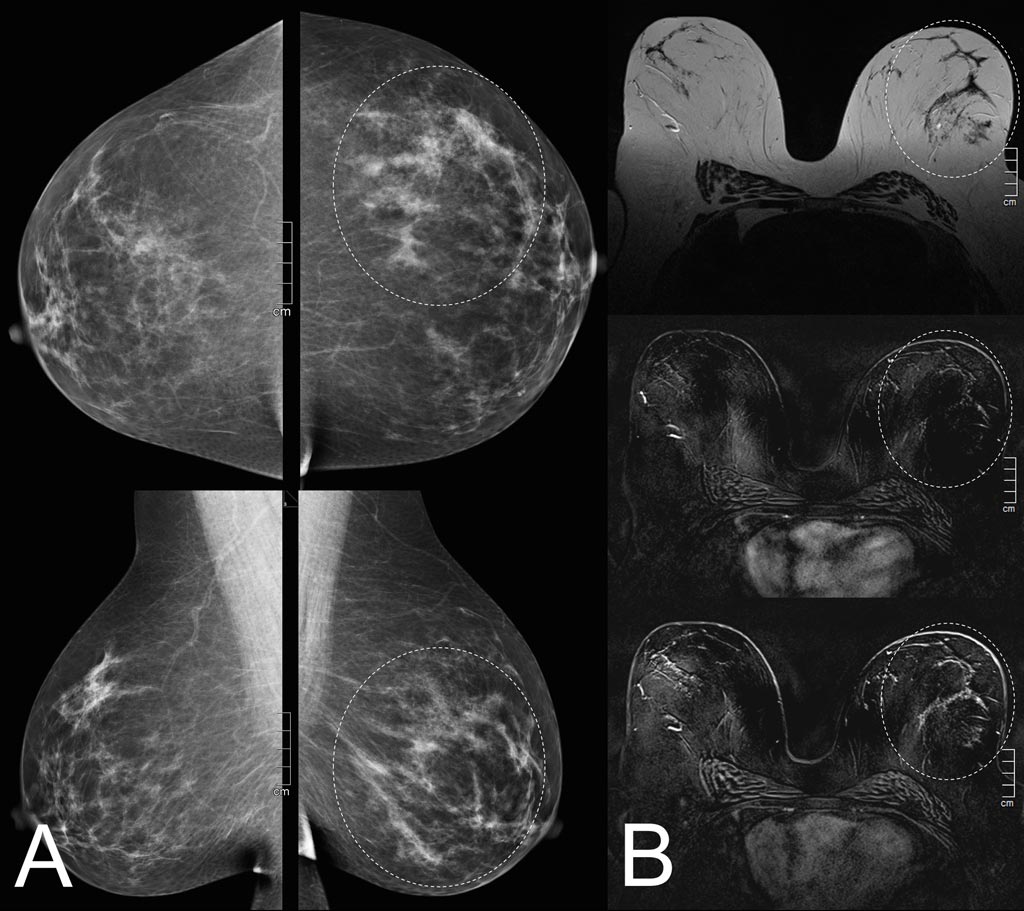 Imagen: La mamografía (A) y la resonancia magnética (B) revelan que un hallazgo sospechoso es solo una mejora leve del fondo (Fotografía cortesía de MedUni).