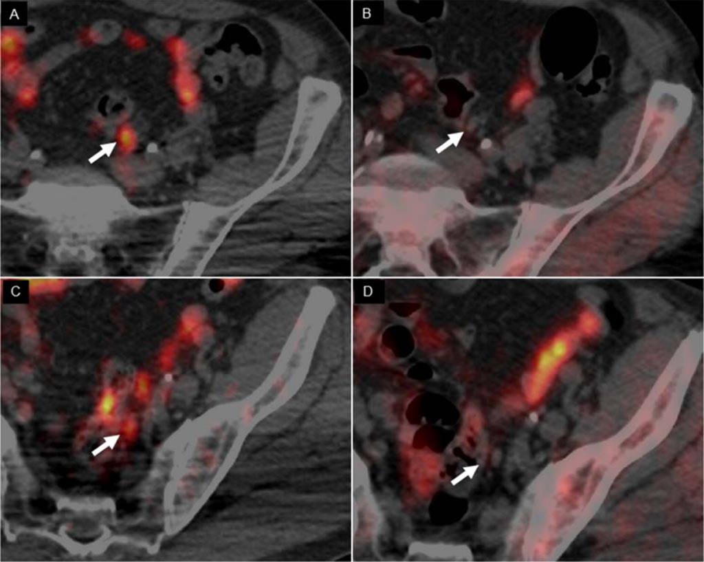 Imagen: Las imágenes de la TEP/TC con 64CuCl2, revelan dos ganglios linfáticos pequeños positivos (A, C), mientras que la TEP/TC con 18F-Colina (B, D) no los muestra (Fotografía cortesía de Arnoldo Piccardo/Hospital Galliera).