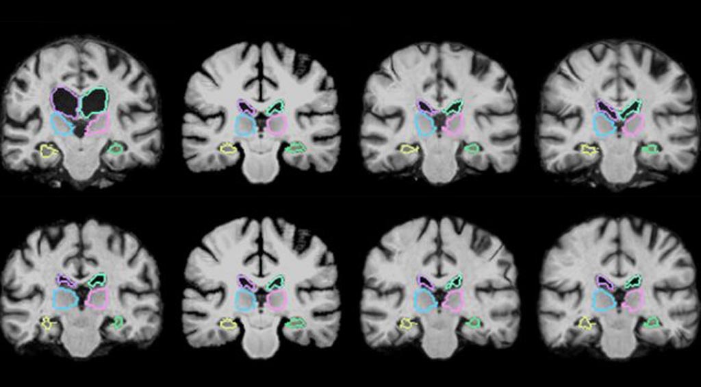Imagen: El algoritmo VoxelMorph permite el registro de los exámenes cerebrales y de otras imágenes en 3D más de 1.000 veces más rápido usando técnicas de aprendizaje novedosas (Fotografía cortesía del MIT).