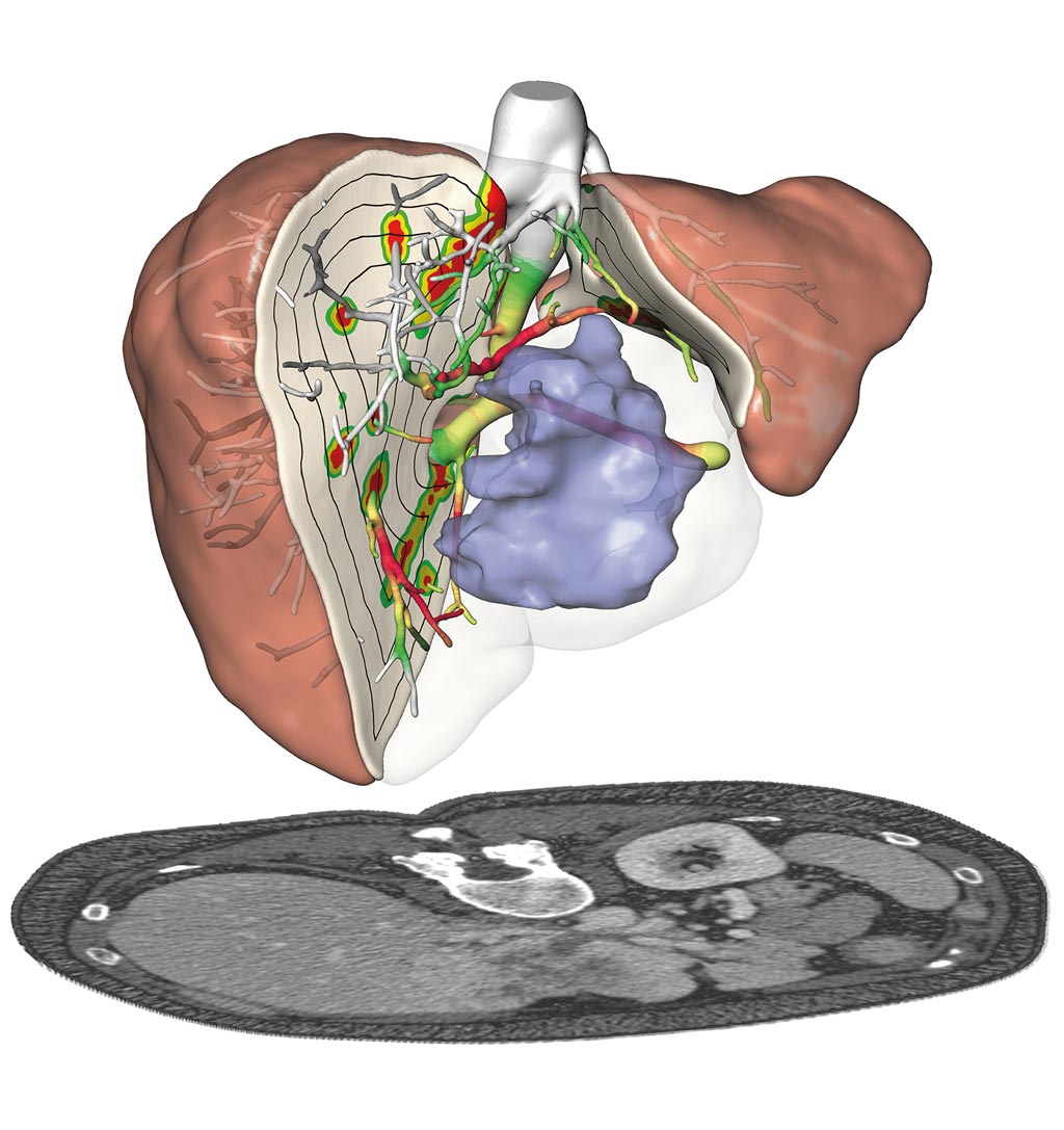 Imagen: Unos nuevos algoritmos analizan los datos de imágenes de los pacientes y calculan los riesgos quirúrgicos, lo que hace que la cirugía de cáncer de hígado sea más segura (Fotografía cortesía del Instituto Fraunhofer para Computación de Imágenes Médicas MEVIS).