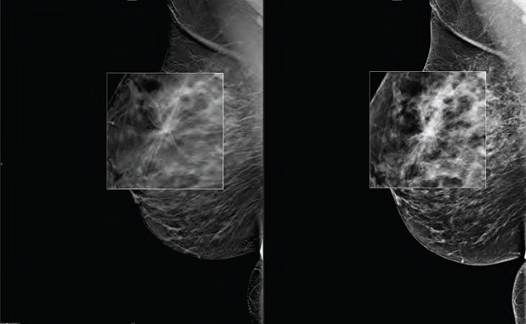 Imagen: Un nuevo estudio afirma que la TDM puede aumentar las tasas de detección del cáncer de mama (Fotografía cortesía de Carestream Health).