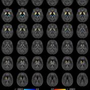 Imagen: Una técnica de resonancia magnética altamente exacta puede monitorizar los niveles de hierro en el cerebro de los pacientes con esclerosis múltiple (Fotografía cortesía de la RSNA).