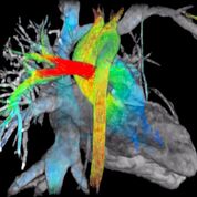 Imagen: Un estudio nuevo sugiere que la resonancia magnética cardíaca puede ayudar a detectar el lupus antes de que aparezcan los síntomas (Fotografía cortesía de GE Healthcare).