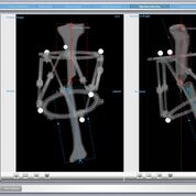 Imagen: El software de análisis radiográfico ayuda a corregir fracturas y deformidades complejas (Fotografía cortesía de AMDT Holdings).