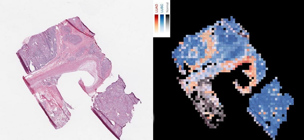 Imagen: Una herramienta de IA analiza una porción de tejido canceroso para crear un mapa que diferencia dos tipos de cáncer de pulmón, con el carcinoma escamocelular en rojo, el carcinoma escamocelulares de pulmón en azul y tejido normal de pulmón en gris (Fotografía cortesía de Cision).