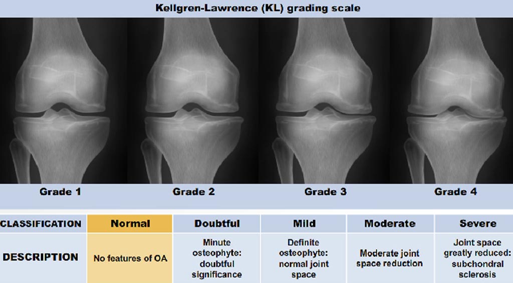 Imagen: El sistema de clasificación KL para evaluar la gravedad de la OA de rodilla. Un algoritmo nuevo de la UCSF ayudará a detectar la OA usando este sistema (Fotografía cortesía de la Universidad de California, San Francisco).