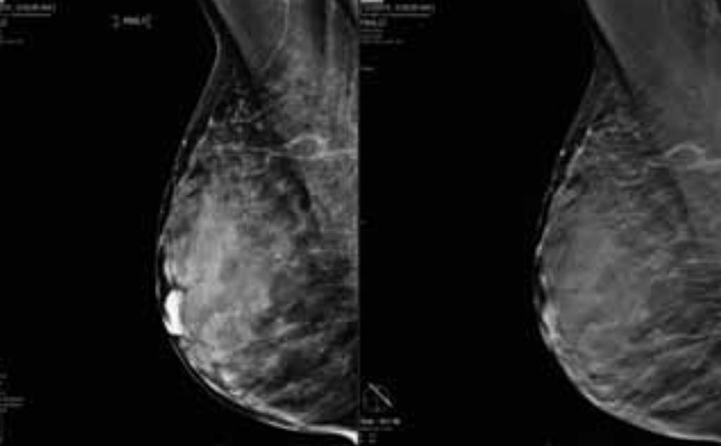 Imagen: Un estudio nuevo afirma que la inteligencia artificial utilizada con la mamografía 3D ofrece mejoras en el desempeño clínico y los tiempos de lectura (Fotografía cortesía de iCad).