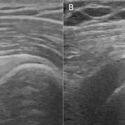Imagen: A muestra el gradiente normal del músculo deltoides; B muestra reversión en un paciente con DM2. D: Deltoides, S: Supraespinoso, H: Húmero (Fotografía cortesía de RSNA).