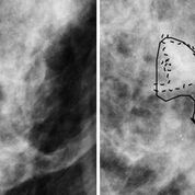 Imagen: Una mujer de 50 años de edad con cáncer invasivo sin (I) y con (D) delineaciones hechas por el radiólogo y por una computadora (Fotografía cortesía de Karen Drukker/Universidad de Chicago).