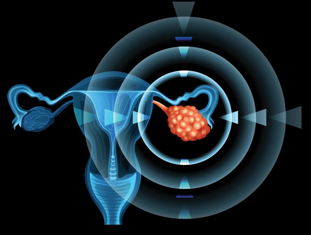 Imagen: El nuevo software puede predecir el pronóstico de las pacientes con cáncer de ovario con mayor exactitud que los métodos actuales (Fotografía cortesía de Getty Images). Imagen: El nuevo software puede predecir el pronóstico de las pacientes con cáncer de ovario con mayor exactitud que los métodos actuales (Fotografía cortesía de Getty Images).