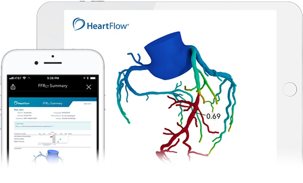 Imagen: HeartFlow desarrolla un software de análisis de IA no invasivo para crear modelos en 3D de las arterias coronarias a partir de tomografías computarizadas (Fotografía cortesía de HeartFlow).
