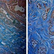 Imagen: Tumor sensible a la radiación (I), y tumor resistente a la radiación (D). Los tumores sensibles tienen más colágeno (azul) (Fotografía cortesía de la Universidad de Arkansas).