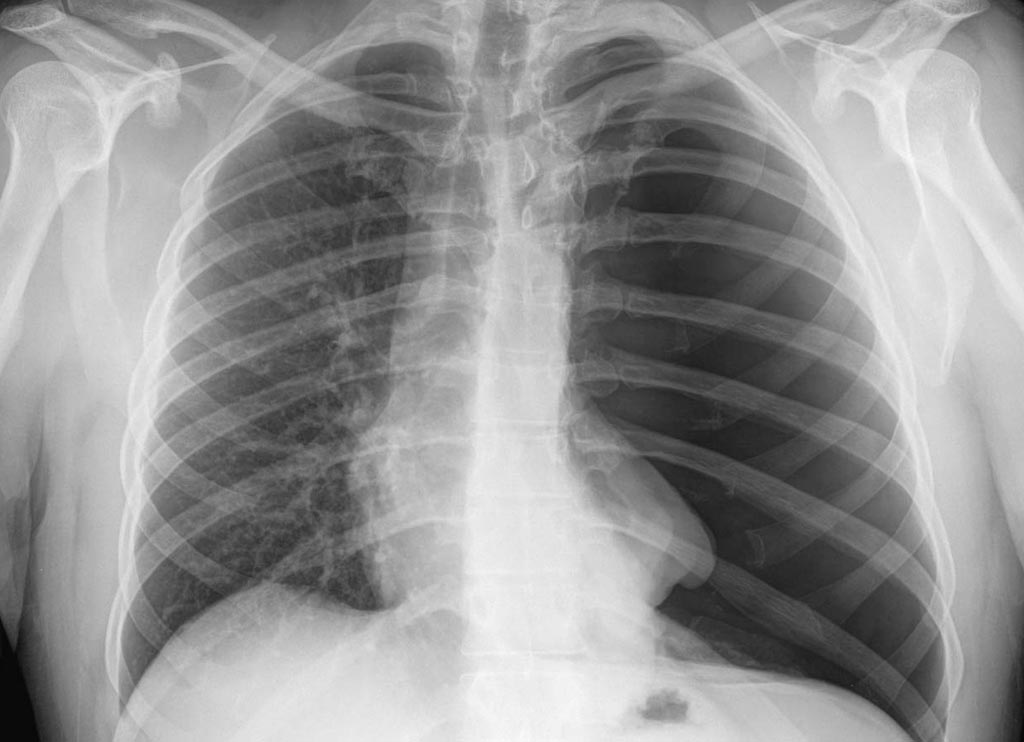 Imagen: El nuevo algoritmo puede señalar un neumotórax en una radiografía de tórax (Fotografía cortesía de iStock). Imagen: El nuevo algoritmo puede señalar un neumotórax en una radiografía de tórax (Fotografía cortesía de iStock).