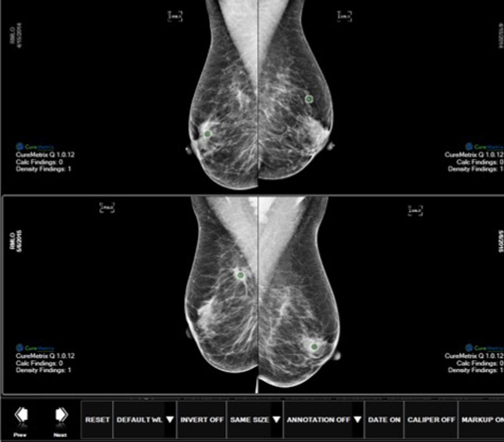 Imagen: El software cmTriage permite a un radiólogo personalizar, clasificar y priorizar su lista de trabajo de mamografía en función de los casos que pueden necesitar atención inmediata (Fotografía cortesía de CureMetrix).