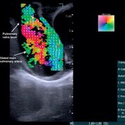 Imagen: Las imágenes de flujo vectorial muestran un flujo de sangre en remolinos (Fotografía cortesía de Morten Jensen/ UARK). Imagen: Las imágenes de flujo vectorial muestran un flujo de sangre en remolinos (Fotografía cortesía de Morten Jensen/ UARK).