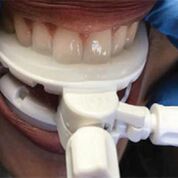 Imagen: El stent dental con desplazamiento de la lengua, GrayDuck (Fotografía cortesía de CIVCO Radiotherapy). Imagen: El stent dental con desplazamiento de la lengua, GrayDuck (Fotografía cortesía de CIVCO Radiotherapy).
