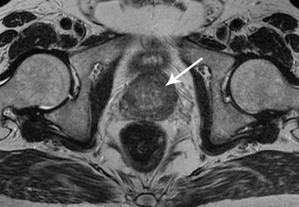 Imagen: El sistema nuevo de inteligencia artificial diseñado para ayudar a los radiólogos a mejorar su capacidad para diagnosticar el cáncer de próstata (Fotografía cortesía de Shutterstock). Imagen: El sistema nuevo de inteligencia artificial diseñado para ayudar a los radiólogos a mejorar su capacidad para diagnosticar el cáncer de próstata (Fotografía cortesía de Shutterstock).
