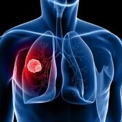 Imagen: Un estudio nuevo afirma que la detección mediante TC reduce la mortalidad por cáncer de pulmón (Fotografía cortesía de Shutterstock). Imagen: Un estudio nuevo afirma que la detección mediante TC reduce la mortalidad por cáncer de pulmón (Fotografía cortesía de Shutterstock).
