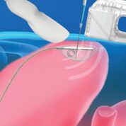 Imagen: El sistema PUMA-G proporciona un procedimiento de gastrostomía por ultrasonido percutáneo que se puede realizar rápida y fácilmente en los puntos de atención (Fotografía cortesía de CoapTech). Imagen: El sistema PUMA-G proporciona un procedimiento de gastrostomía por ultrasonido percutáneo que se puede realizar rápida y fácilmente en los puntos de atención (Fotografía cortesía de CoapTech).