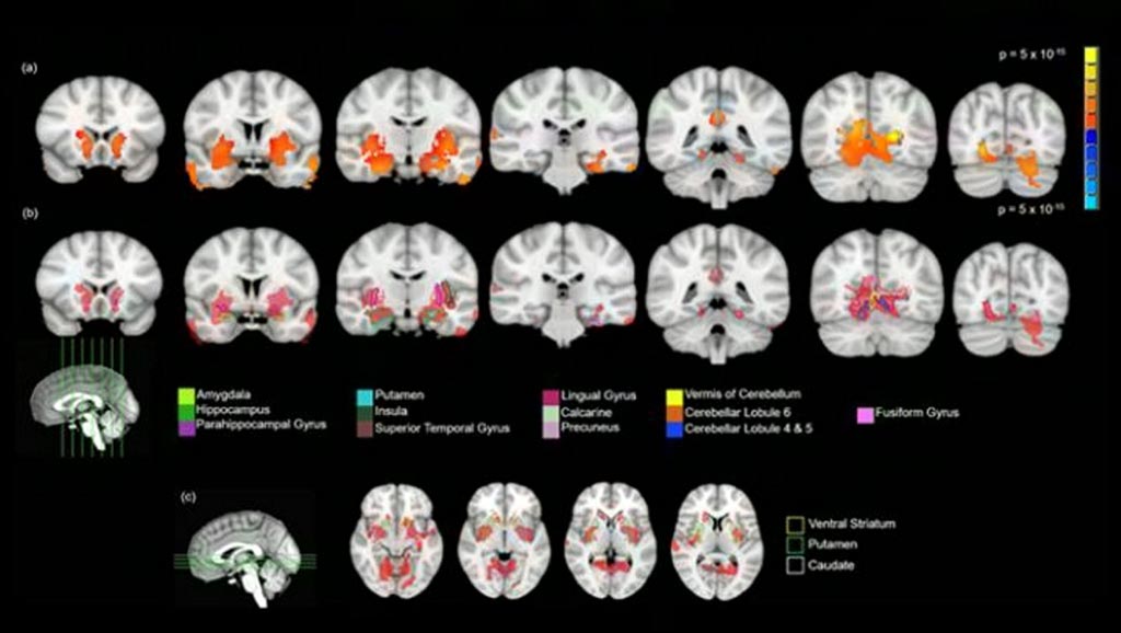 Imágenes: Regiones que muestran mayor VMG en los jóvenes de 14 años que fumaron cannabis (Fotografía cortesía de la revista Journal of Neuroscience).
