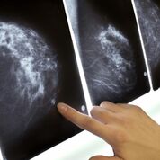 Imagen: Un estudio nuevo afirma que los radiólogos pueden discernir el cáncer de mama años antes de las lesiones clínicas (Fotografía cortesía de Getty Images). Imagen: Un estudio nuevo afirma que los radiólogos pueden discernir el cáncer de mama años antes de las lesiones clínicas (Fotografía cortesía de Getty Images).