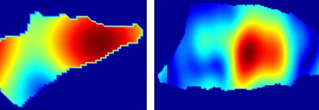 Imagen: Los patrones de reflectividad pueden diferenciar entre el carcinoma basocelular (I) y el carcinoma escamocelular (D) (Fotografía cortesía del Instituto de Tecnología Stevens).