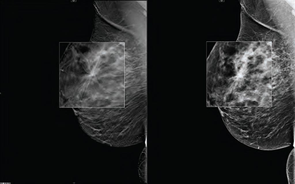 Imagen: Comparación de la tomosíntesis digital de mama con la mamografía (Fotografía cortesía de Carestream Health).