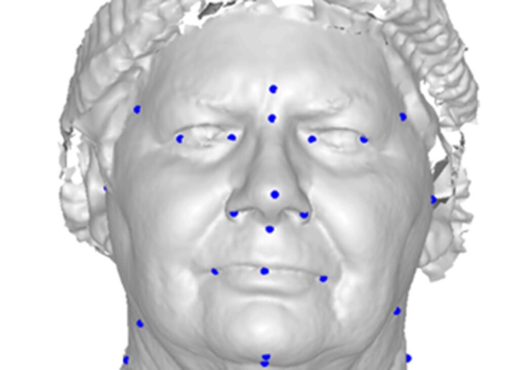 Imagen: Un estudio nuevo afirma que la fotografía facial en 3D puede predecir la AOS (Fotografía cortesía de la UWA).