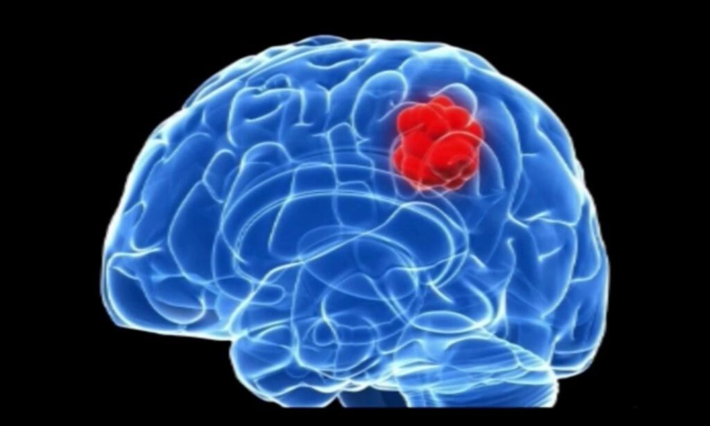 Imagen: Una investigación nueva sugiere que los modelos espaciales pueden ayudar a mejorar los tratamientos con radioterapia para los glioblastomas (Fotografía cortesía de Getty Images). Imagen: Una investigación nueva sugiere que los modelos espaciales pueden ayudar a mejorar los tratamientos con radioterapia para los glioblastomas (Fotografía cortesía de Getty Images).