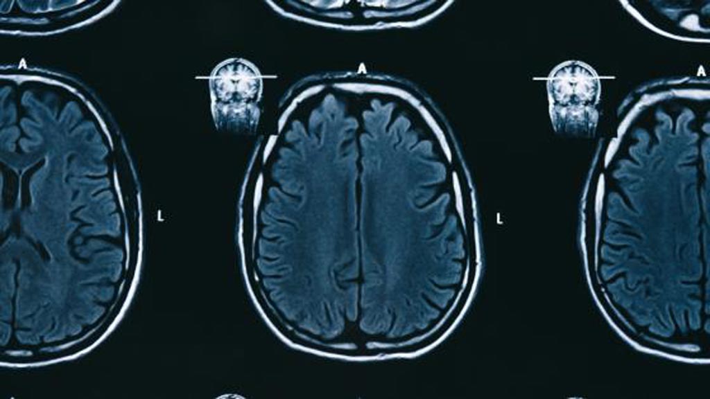 Imagen: El producto de IA de Subtle Medical, SubtleGAD, reduce el gadolinio necesario durante los exámenes de resonancia magnética sin sacrificar la calidad del diagnóstico (Fotografía cortesía de iStock). Imagen: El producto de IA de Subtle Medical, SubtleGAD, reduce el gadolinio necesario durante los exámenes de resonancia magnética sin sacrificar la calidad del diagnóstico (Fotografía cortesía de iStock).