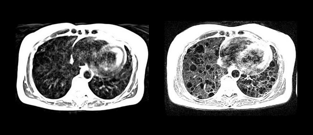 Imagen: Los quistes pulmonares se ven con más claridad con la RM de campo bajo de alto rendimiento (D) en comparación con la RM estándar (I) (Fotografía cortesía de Adrienne Campbell-Washburn/NIH).